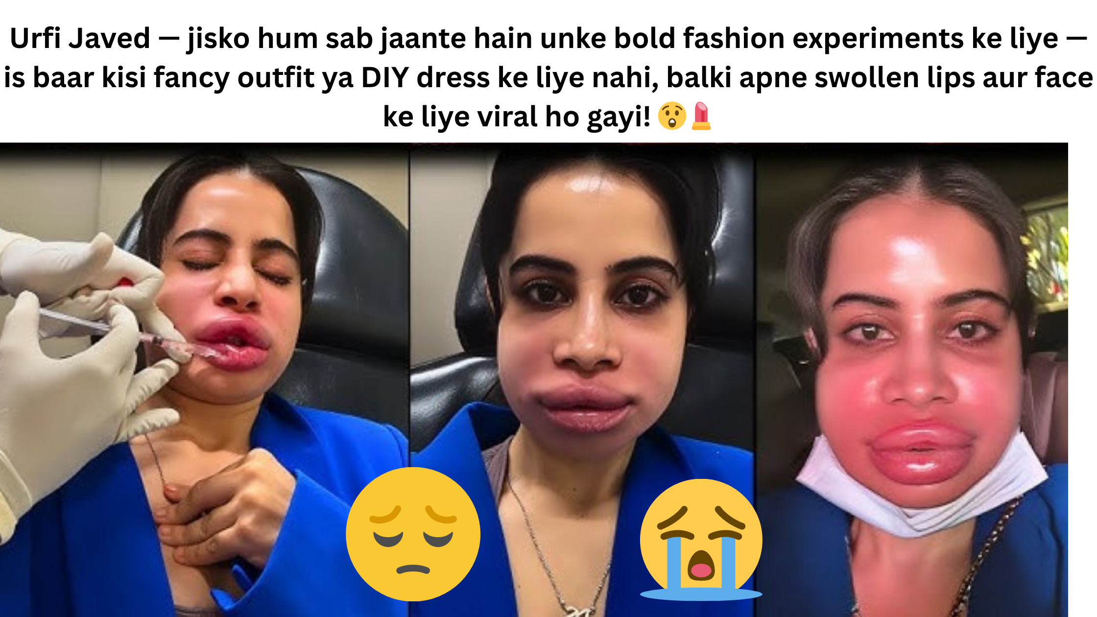 🌟 Introduction: Drama Queen Urfi Strikes Again! 🌟 Urfi Javed — jisko hum sab jaante hain unke bold fashion experiments ke liye — is baar kisi fancy outfit ya DIY dress ke liye nahi, balki apne swollen lips aur face ke liye viral ho gayi! 😲💄